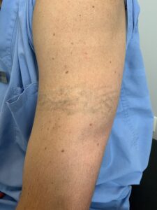 Tattoo Removal After Image
