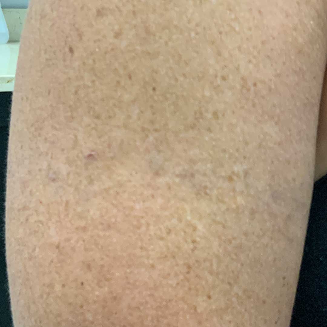 Tattoo Removal After Image