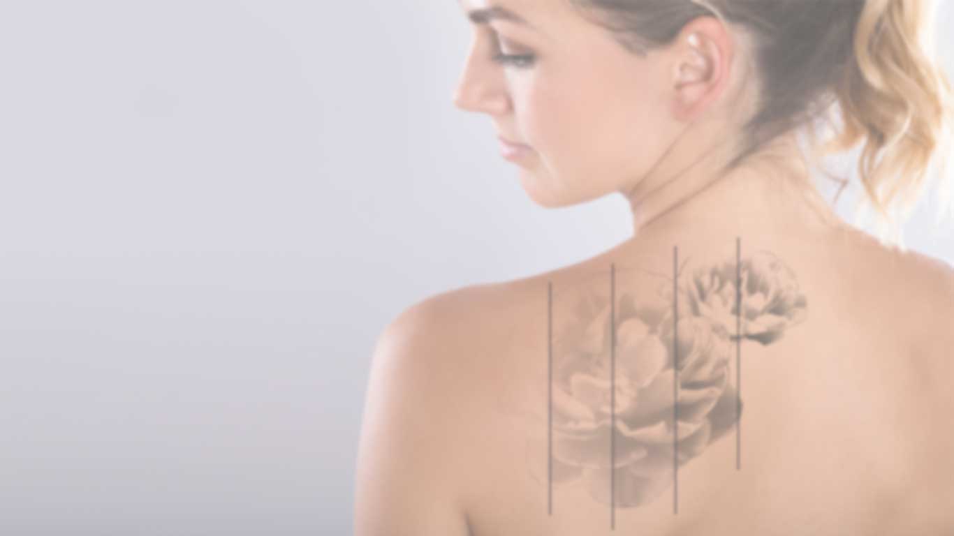 5090-b » TakeTatt Tattoo Removal